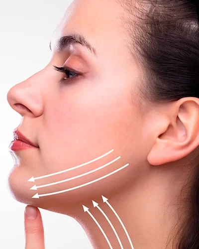 Hilos tensores radiesse